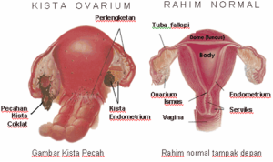 obat kista ovarium